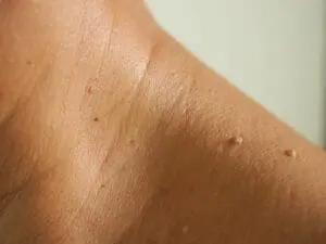 skin-tags-on-shoulder-lower-neck