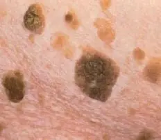 Freeze seborrheic keratosis
