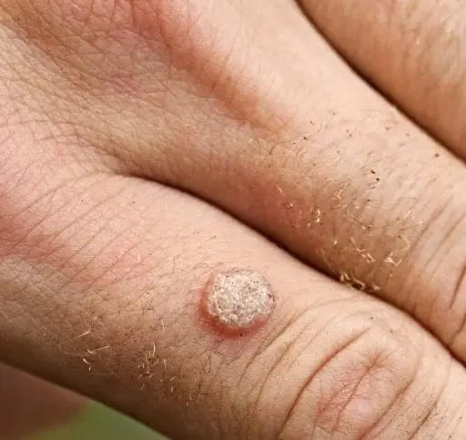 skin-condition-to-be-treated-by-cryotherapy